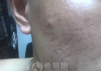 痘坑能改善到什么程度？小羊的真實經歷告訴你答案