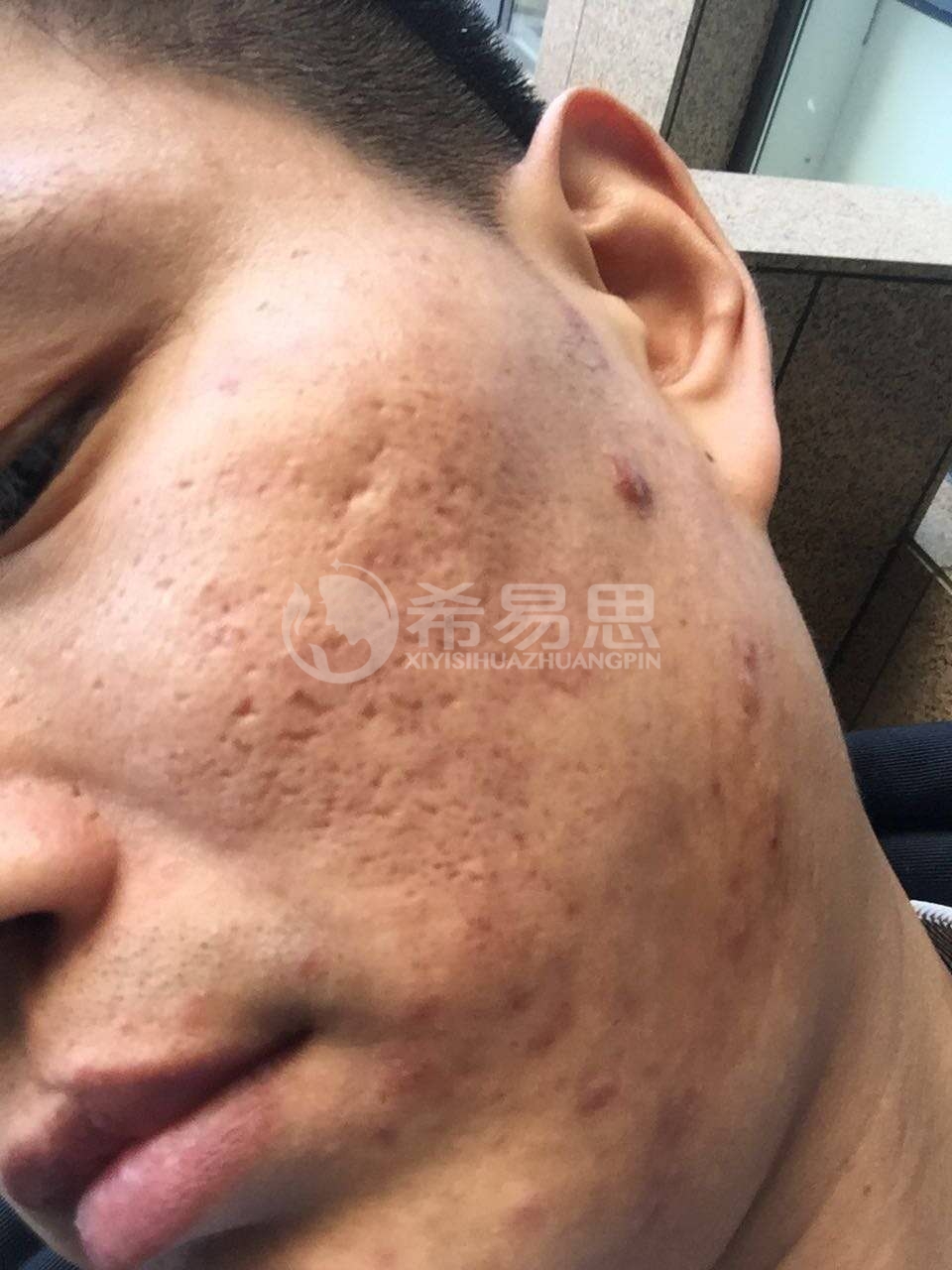 痘印痘坑如何修復？你還在為不知道如何去除痘印痘坑而煩惱嗎？